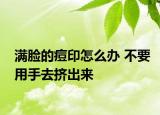 滿臉的痘印怎么辦 不要用手去擠出來(lái)