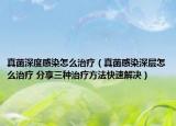 真菌深度感染怎么治療（真菌感染深層怎么治療 分享三種治療方法快速解決）