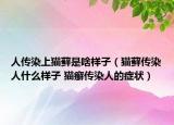 人傳染上貓?zhí)\是啥樣子（貓?zhí)\傳染人什么樣子 貓癬傳染人的癥狀）