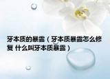 牙本質(zhì)的暴露（牙本質(zhì)暴露怎么修復(fù) 什么叫牙本質(zhì)暴露）