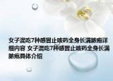 女子混吃7種感冒止咳藥全身長(zhǎng)滿膿皰詳細(xì)內(nèi)容 女子混吃7種感冒止咳藥全身長(zhǎng)滿膿皰具體介紹