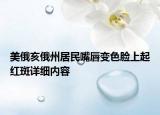 美俄亥俄州居民嘴唇變色臉上起紅斑詳細(xì)內(nèi)容