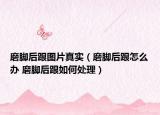 磨腳后跟圖片真實（磨腳后跟怎么辦 磨腳后跟如何處理）